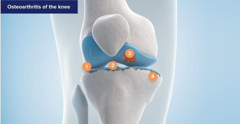 Illustration de l’articulation du genou montrant les os et le cartilage